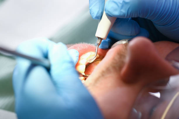 Tooth Infection Emergency Dentist in CO