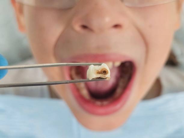 Best Knocked-Out Tooth Emergency  in Minturn, CO